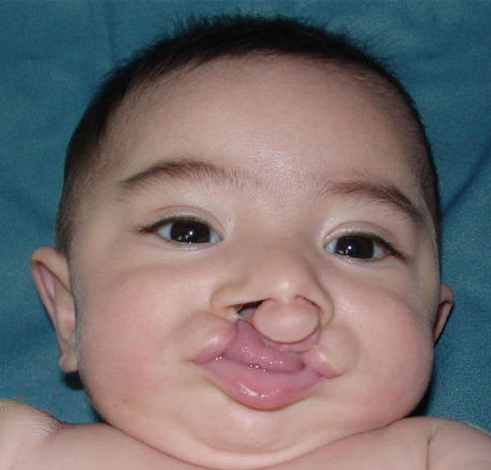 Maximiliano as a baby, before cleft surgery