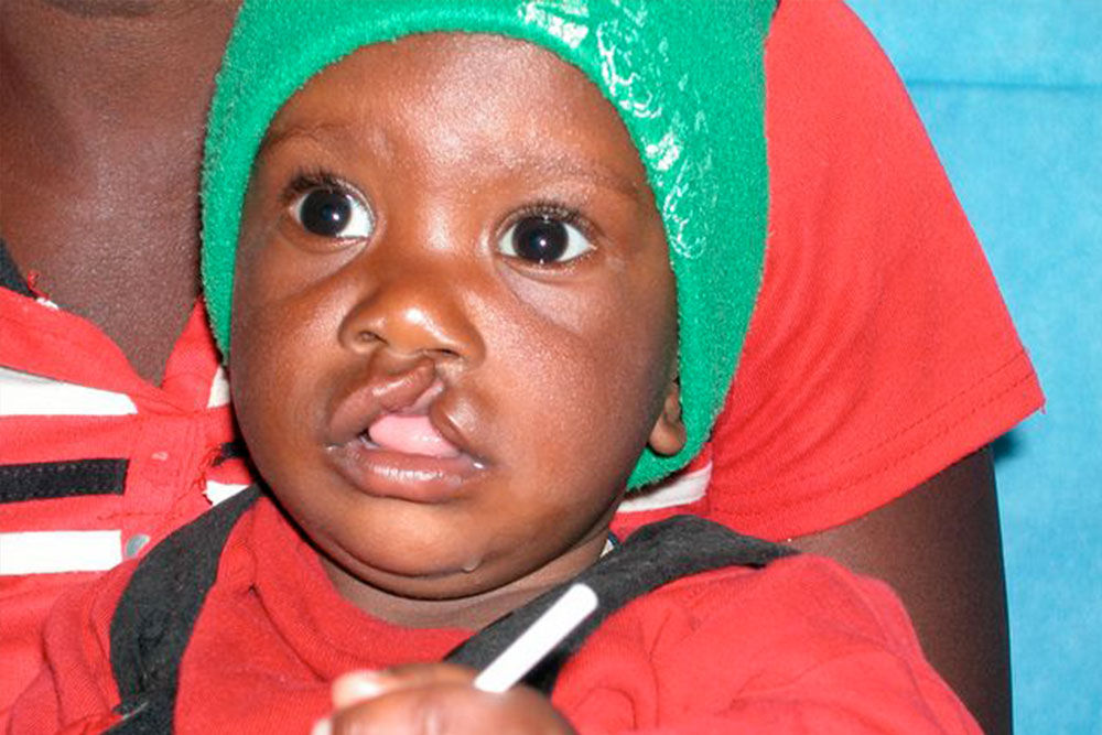 Mercy as a baby, before cleft surgery